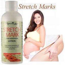 ストレッチマーク(Stretchmark Lotion)8oz/240ml